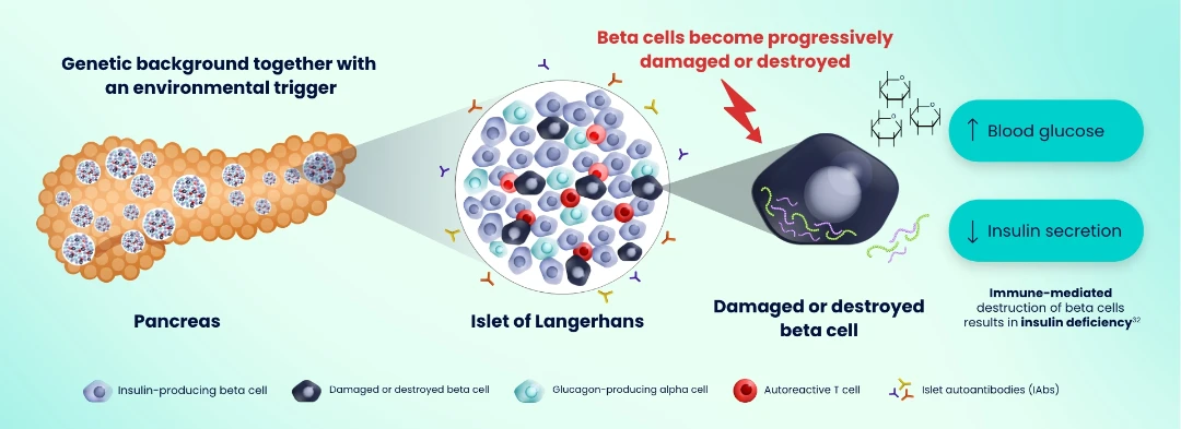 Diagram showing type 1 diabetes progression: genetic and environmental triggers damage pancreatic beta cells, leading to increased blood glucose and decreased insulin secretion.